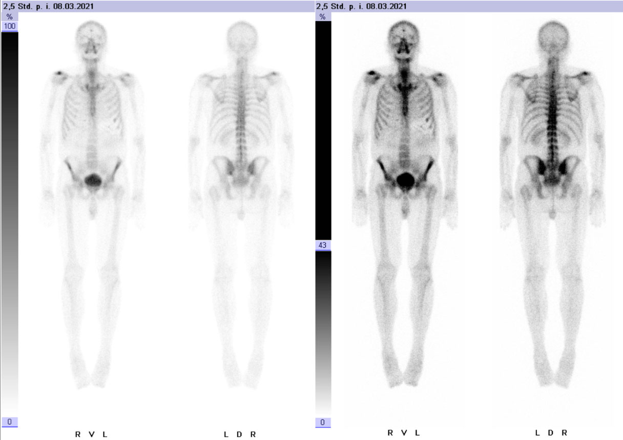 Knochenszintigrafie in der Nuklearmedizin: Frage nach Prothesenlockerung, Entzündung, Metastasen